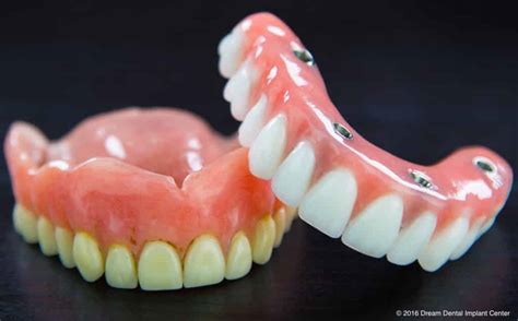 affordable dentures and implants